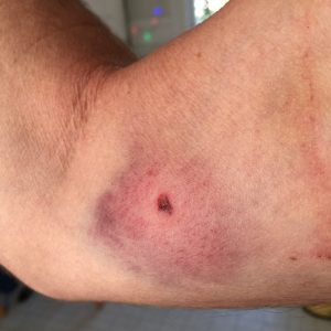 wound